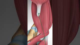 Distal Biceps Tendon Rupture and Repair bicepstendon elbowpain biceps [upl. by Ahsiak]