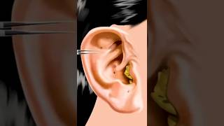 Ear Cleaning Stone Removal  ASMR  Itchy amp Smelly Ear Cleaning shorts [upl. by Lorrie]