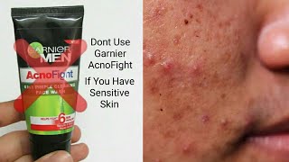 How To Remove Pimples With Using Garnier AcnoFight Face Wash [upl. by Calla908]