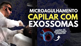 Microagulhamento CAPILAR com EXOSSOMAS  Aula prática [upl. by Granniah]