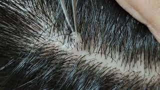 Relaxing dandruff removal w tweezers 15 02sleepyheads  visual ASMR oddlysatisfying [upl. by Rexferd]