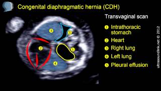 Congenital diaphragmatic hernia CDH at 12 weeks gestation [upl. by Morrison]