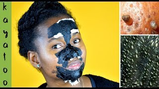 VOILA COMMENT ENLEVER VOS COMÉDONS DU VISAGE MASQUE NOIR SANS COLLE  KAYATOO [upl. by Ateekahs]