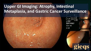 Upper GI Imaging Atrophy Intestinal Metaplasia and Gastric Cancer Surveillance [upl. by Fay291]