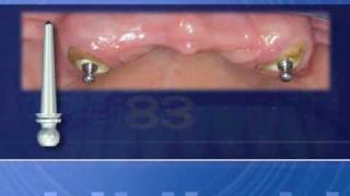 Rhein83 Root Retained Overdentures [upl. by Naghem]