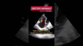 Ebstein Anomaly on Echocardiography [upl. by Gertruda985]