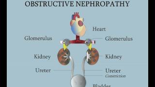 Obstrucción de la unión ureterovesical [upl. by Snider]