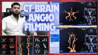 CT SCAN BRAIN ANGIOGRAPHY FILMING PROCESS ON PHILIPS INGENUITY MACHINE SOFTWARE  Circle of willis [upl. by Ard]