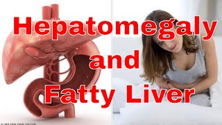 Hepatomegaly with Fatty Liver [upl. by Gnohp450]