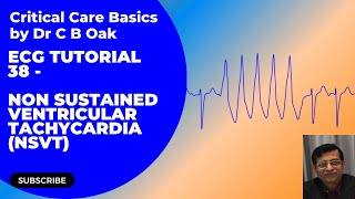 ECG Tutorial 38 Non sustained Ventricular Tachycardia [upl. by Nauqan]