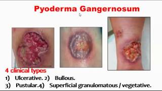 Pyoderma gangernosum [upl. by Isle879]