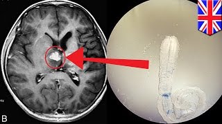 Tapeworm infection Rare brain worm took 4 years to crawl across UK man’s brain [upl. by Durwin416]