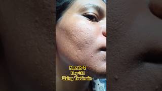 Day32 Using Tretinoin 0025 cream viralvideo tretinoin skincare shorts youtubeshorts [upl. by Klapp]