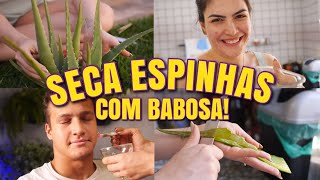 SECA ESPINHAS SUPER RÁPIDO E INFALÍVEL  Receita Natural com Babosa [upl. by Shumway]