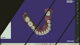 Exocad ortho orthodontics modules [upl. by Selokcin11]