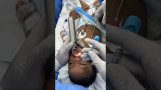 Intubating a cleft kid  Richardsons by our pediatric cardiac anesthesiologist and his team [upl. by Acenahs]