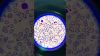 thalassemia peripheral blood smears with hypochromic microcytic red blood cells and poikilocytosis [upl. by Weingartner]