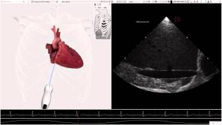 HeartWorks Hypovolemia [upl. by Marcel]