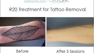 R20 Laser Tattoo Removal Technique [upl. by Derward]