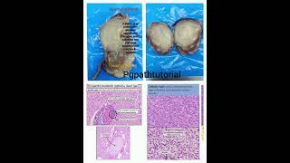 Crisp summary of congenital mesoblastic nephroma a NTRK positive tumor [upl. by Aihcats]