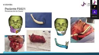 Espaciadores personalizados en PMMA con CAD e impresión 3D herramienta emergente en tumores [upl. by Ruyam]