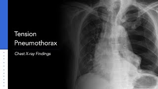 Tension Pneumothorax Explanation of Chest Xray Findings [upl. by Epolulot794]