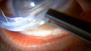 Bruder ProKera Lens Forceps Video [upl. by Lehpar]