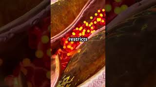 “Atherosclerosis Explained in 50 Seconds”hearthealth wellnesstips medfacts ournursesourfuture [upl. by Nonna409]