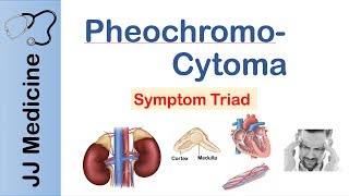 Pheochromocytoma  Symptoms and Treatment [upl. by Zosima]