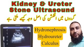 Kidney stone  ureter stone  Hydronephrosis  Hydroureter  Dr Qazi Fahim Shezad [upl. by Eniamrehc526]