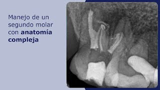 Manejo de un segundo molar con anatomía compleja [upl. by Galina]