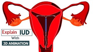 How does an IUD work  Understanding IUDs  Animated Guide  3D animation [upl. by Ttenneb377]