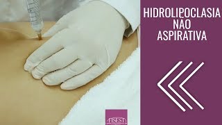 Hidrolipoclasia não Aspirativa Lipo Não Invasiva  Fisest [upl. by Chud211]