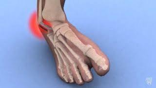 Mayo Clinic Minute Ankle sprains 101 [upl. by Eelnyl]