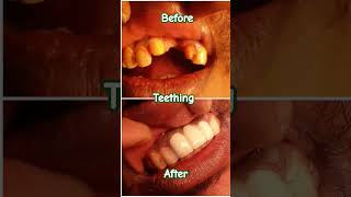 Teething smile bdshorts dentistry dentist dentalcare [upl. by Cyb75]