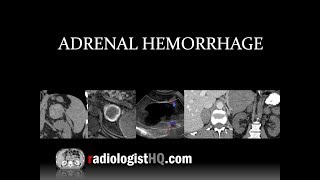 Adrenal Hemorrhage [upl. by Fleck175]