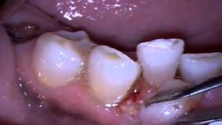 MD Epulis Removal [upl. by Brady]