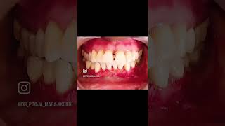 Periodontist gums depigmentation gingivaldepigmentation scalpel blackgums esthetics smile [upl. by Patt209]