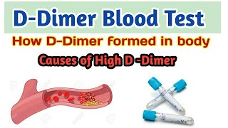 DDimer Blood Test  Causes of high d dimerFalse positive d dimer  sample for D dimer test [upl. by Jordanson]