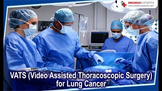 VATS Video Assisted Thoracoscopic Surgery for Lung Cancer [upl. by Alyled823]