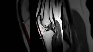 Patella alta and fatty impingement [upl. by Natascha]