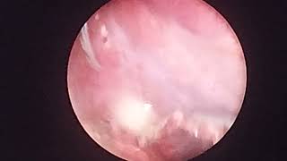 laparoscopic appendectomy in appendicular lump [upl. by Laaspere]