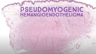 Pseudomyogenic hemangioendothelioma epithelioid sarcoma mimicAustralasian Dermpath 2022 Case 10 [upl. by Gwennie686]