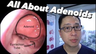 Adenoids and Adenoidectomy what are they when do we remove them what is the surgery like [upl. by Rehpotsrik102]