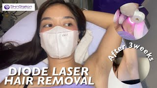 DIODE LASER HAIR REMOVAL  SKINSTATION 1st Session [upl. by Saitam333]