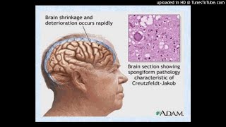 Prion diseases or transmissible spongiform encephalopathies TSEs [upl. by Jariv]