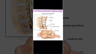 Lumbar puncture nursingschoolstudents lunbarpuncturespinalcordinjury vkxrmanursingnotes [upl. by West33]