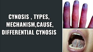 Cyanosis  General Examination  clinical practice Pathology  Online classes for medical students [upl. by Macomber]