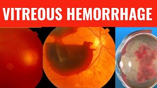 VITREOUS HEMORRHAGE  Everything you need to know [upl. by Ferdinande]