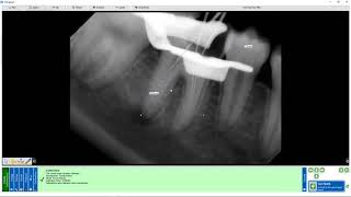 Training Apteryx XrayVision DCV Image Calibration and Measurement [upl. by Ailime889]